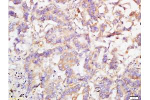 Formalin-fixed and paraffin embedded human lung cancer labeled with Rabbit Anti-TRIB2 Polyclonal Antibody, Unconjugated  at 1:200 followed by conjugation to the secondary antibody and DAB staining (TRIB2 anticorps  (AA 151-250))