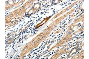 The image on the left is immunohistochemistry of paraffin-embedded Human gastric cancer tissue using ABIN7192673(STEAP4 Antibody) at dilution 1/25, on the right is treated with synthetic peptide.