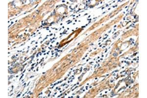 The image on the left is immunohistochemistry of paraffin-embedded Human gastric cancer tissue using ABIN7192673(STEAP4 Antibody) at dilution 1/25, on the right is treated with synthetic peptide. (STEAP4 anticorps)