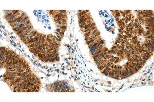 Immunohistochemistry of paraffin-embedded Human colon cancer tissue using SP1 Polyclonal Antibody at dilution 1:30