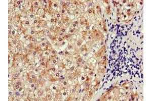 Immunohistochemistry of paraffin-embedded human liver cancer using ABIN7170291 at dilution of 1:100