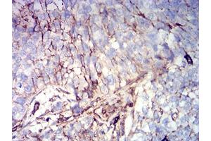Immunohistochemical analysis of paraffin-embedded bladder cancer tissues using CD44 mouse mAb with DAB staining.