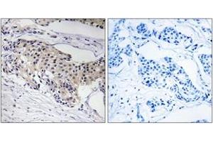 Immunohistochemistry analysis of paraffin-embedded human breast carcinoma tissue, using NDUFA3 Antibody. (NDUFA3 anticorps  (AA 34-83))