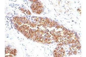 Formalin-fixed, paraffin-embedded human breast carcinoma stained with MUC1 / EMA antibody (MUC1/845).