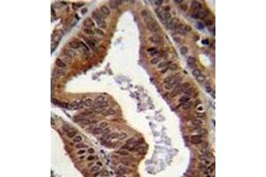 Formalin fixed and paraffin embedded human prostate carcinoma reacted with TTRAP Antibody (C-term) followed by peroxidase conjugation of the secondary antibody and DAB staining.