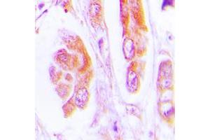 Immunohistochemical analysis of Caspase 7 staining in human lung cancer formalin fixed paraffin embedded tissue section. (Caspase 7 anticorps  (Center))