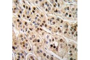 IHC analysis of FFPE human hepatocarcinoma tissue stained with PCNA antibody (PCNA anticorps  (AA 231-261))
