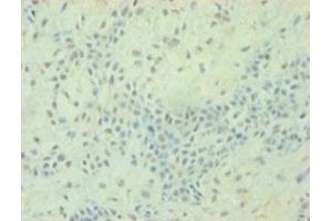 Immunohistochemistry of paraffin-embedded human breast cancer using ABIN7172823 at dilution of 1:100 (TGFB2 anticorps  (AA 304-413))