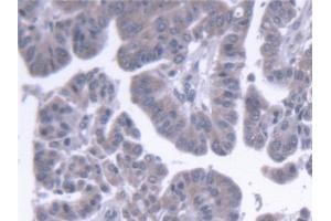 Detection of ERLIN2 in Human Liver cancer Tissue using Polyclonal Antibody to Endoplasmic Reticulum Lipid Raft Associated Protein 2 (ERLIN2)