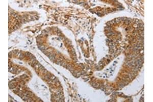 The image on the left is immunohistochemistry of paraffin-embedded Human colon cancer tissue using ABIN7191632(NEUROG1 Antibody) at dilution 1/25, on the right is treated with synthetic peptide.