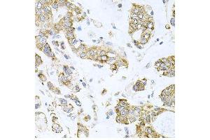 Immunohistochemistry of paraffin-embedded human gastric cancer using ALKBH8 antibody. (ALKBH8 anticorps  (AA 1-230))