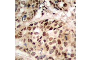 Immunohistochemical analysis of PHF1 staining in human prostate cancer formalin fixed paraffin embedded tissue section.