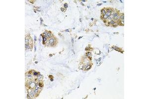 Immunohistochemistry of paraffin-embedded human gastric cancer using GALC antibody.