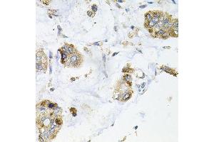 Immunohistochemistry of paraffin-embedded human gastric cancer using GALC antibody. (GALC anticorps  (AA 40-300))
