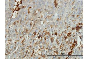 Immunoperoxidase of monoclonal antibody to ALB on formalin-fixed paraffin-embedded human hepatocellular carcinoma tissue.