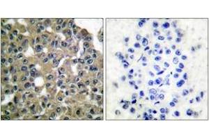 Immunohistochemistry analysis of paraffin-embedded human breast carcinoma tissue, using MAGE-1 Antibody.