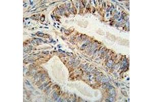 Anti-AKT2 antibody immunohistochemistry analysis in formalin fixed and paraffin embedded human prostate carcinoma.