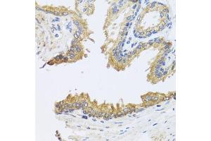 Immunohistochemistry of paraffin-embedded human prostate using ARL6 antibody (ABIN5974886) at dilution of 1/100 (40x lens). (ARL6 anticorps)