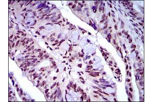 Immunohistochemical analysis of paraffin-embedded rectum cancer tissues using NAPSA mouse mAb with DAB staining. (NAPSA anticorps  (AA 20-158))