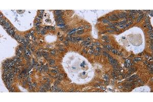 Immunohistochemistry of paraffin-embedded Human colon cancer using GH2 Polyclonal Antibody at dilution of 1:40 (Growth Hormone 2 anticorps)