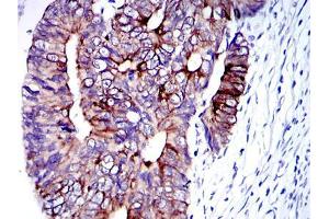 Immunohistochemical analysis of paraffin-embedded human colon cancer tissues using KRT19 mouse mAb with DAB staining. (Cytokeratin 19 anticorps)