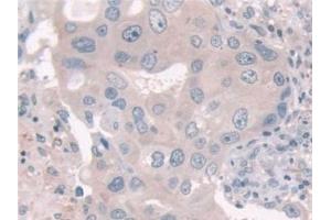 Detection of USP6NL in Human Breast cancer Tissue using Polyclonal Antibody to USP6 N-Terminal Like Protein (USP6NL) (USP6NL anticorps  (AA 1-292))