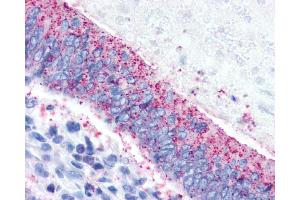 Anti-CRHR2 / CRF2 Receptor antibody IHC of human Colon, Carcinoma.