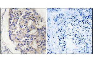 Immunohistochemistry analysis of paraffin-embedded human breast carcinoma tissue, using C1S antibody. (C1S anticorps)
