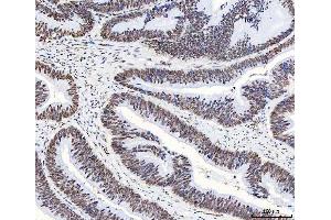 IHC analysis of HnRNP H/HNRNPH1 using anti-HnRNP H/HNRNPH1 antibody (ABIN4886623). (HNRNPH1 anticorps  (N-Term))