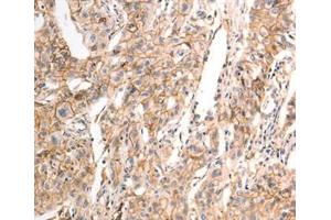 Immunohistochemical analysis of paraffin-embedded Human liver cancer tissue using at dilution 1/30. (CDH23 anticorps  (C-Term))