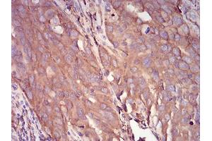 Immunohistochemical analysis of paraffin-embedded ovarian cancer tissues using SERPINA1 mouse mAb with DAB staining.