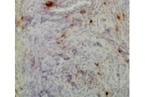 Frozen chicken ovarian tumor section was stained with Mouse Anti-Chicken CD8α-UNLB (CD8 alpha anticorps)