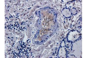 Immunohistochemical staining of human thyroid cancer using anti-CD52 antibody  Formalin fixed human thyroid cancer slices were were stained with a  at 5 µg/ml. (Recombinant CD52 anticorps)