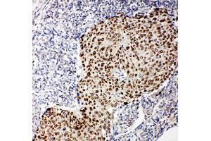 Anti-p63 antibody, IHC(P) IHC(P): Human Lung Cancer Tissue