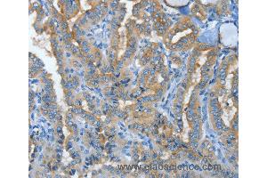 Immunohistochemistry of Human lung cancer using MUC15 Polyclonal Antibody at dilution of 1:50 (MUC15 anticorps)