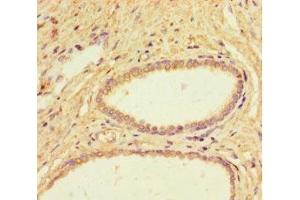 Immunohistochemistry of paraffin-embedded human prostate cancer using ABIN7157778 at dilution of 1:100