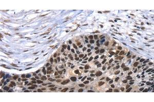 Immunohistochemistry of paraffin-embedded Human esophagus cancer using TAF15 Polyclonal Antibody at dilution of 1:35 (TAF15 anticorps)
