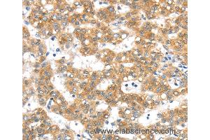 Immunohistochemistry of Human lung cancer using PTPN4 Polyclonal Antibody at dilution of 1:40 (PTPN4 anticorps)