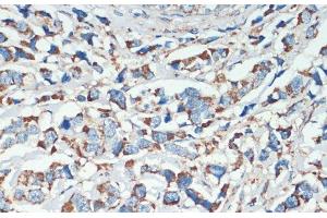 Immunohistochemistry of paraffin-embedded Human breast cancer using APC Polyclonal Antibody at dilution of 1:200 (40x lens). (APC anticorps)