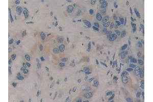 Detection of IGF1 in Human Breast cancer Tissue using Polyclonal Antibody to Insulin Like Growth Factor 1 (IGF1) (IGF1 anticorps  (AA 49-118))