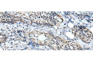 Immunohistochemistry of paraffin-embedded Human cervical cancer tissue using WDFY2 Polyclonal Antibody at dilution of 1:40(x200) (WDFY2 anticorps)