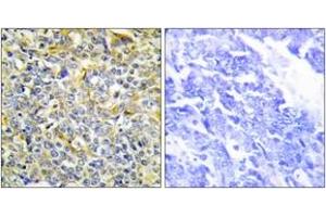 Immunohistochemistry analysis of paraffin-embedded human lung carcinoma tissue, using TFIP8 Antibody. (Cytokeratin 5 anticorps  (AA 31-80))