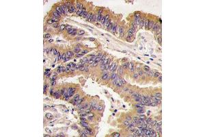Formalin-fixed and paraffin-embedded human lung carcinoma tissue reacted with GDF5 antibody (N-term), which was peroxidase-conjugated to the secondary antibody, followed by DAB staining.