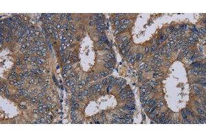 Immunohistochemistry of paraffin-embedded Human colon cancer tissue using NECTIN3 Polyclonal Antibody at dilution 1:40 (nectin-3 anticorps)