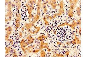 IHC image of ABIN7156517 diluted at 1:300 and staining in paraffin-embedded human liver cancer performed on a Leica BondTM system.