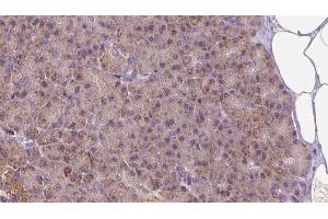 ABIN6273261 at 1/100 staining Human pancreas cancer tissue by IHC-P. (LETM1 anticorps  (Internal Region))