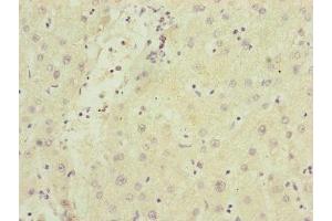 Immunohistochemistry of paraffin-embedded human liver cancer using ABIN7170343 at dilution of 1:100