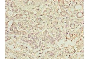 Immunohistochemistry of paraffin-embedded human pancreatic cancer using ABIN7173742 at dilution of 1:100 (TBCC anticorps  (AA 2-346))