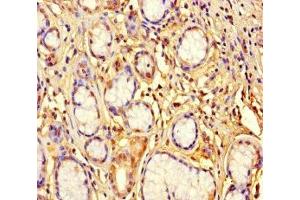 Immunohistochemistry of paraffin-embedded human gastric cancer using ABIN7176457 at dilution of 1:100 (ZNF627 anticorps  (AA 1-300))