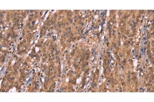 Immunohistochemistry of paraffin-embedded Human gasrtic cancer tissue using FBXO31 Polyclonal Antibody at dilution 1:40 (FBXO31 anticorps)